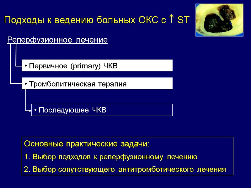 Реперфузионное лечение  Первичное (primary) ЧКВ  Тромболитическая терапия Подходы к ведению больных ОКС